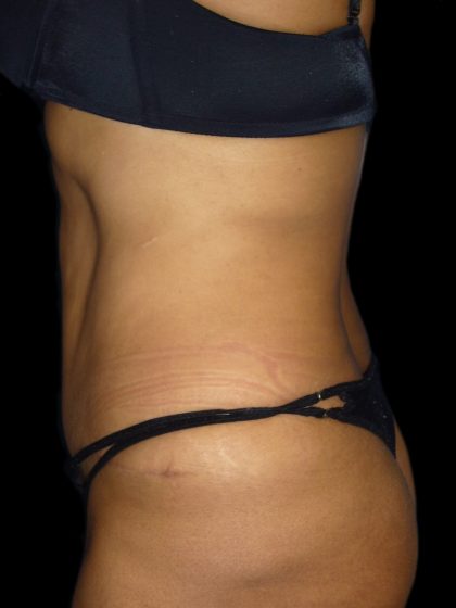 Tummy Tuck Before & After Patient #3155