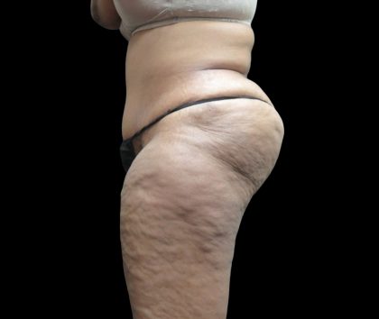 Tummy Tuck Before & After Patient #3209