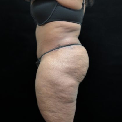 Tummy Tuck Before & After Patient #3267
