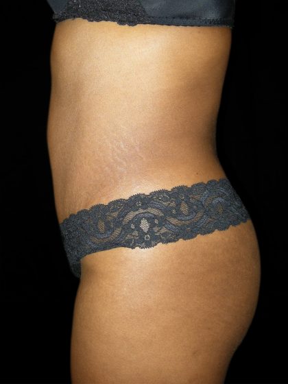 Tummy Tuck Before & After Patient #3366