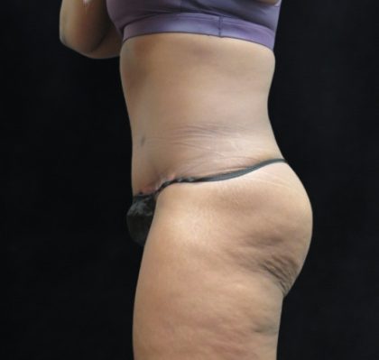 Tummy Tuck Before & After Patient #3387