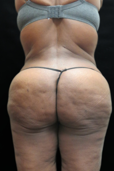 Tummy Tuck Before & After Patient #3412