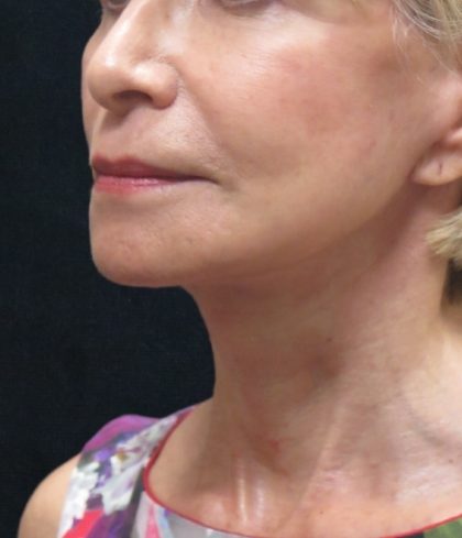 Levinelift Before & After Patient #2008
