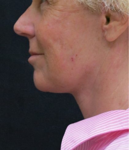 Levinelift Before & After Patient #1999