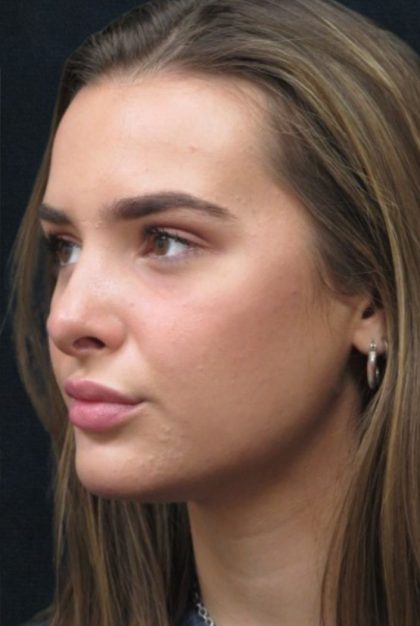 Rhinoplasty Before & After Patient #2926