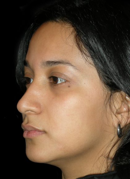 Rhinoplasty Before & After Patient #2905