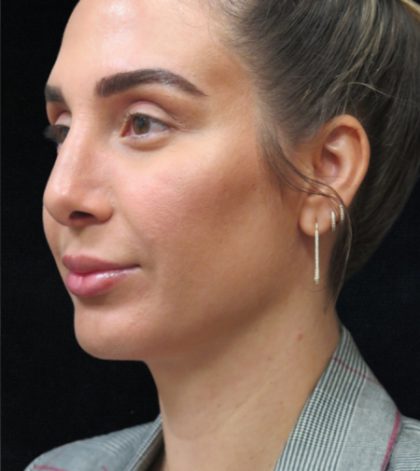 Rhinoplasty Before & After Patient #2851