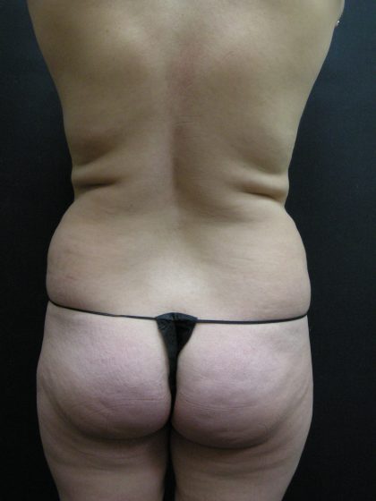Mommy Makeover Before & After Patient #2657