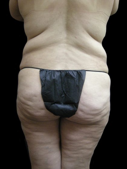 Lower Body Lift Before & After Patient #2316