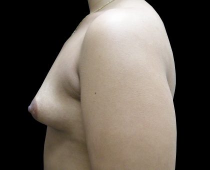 Breast Asymmetry Before & After Patient #965