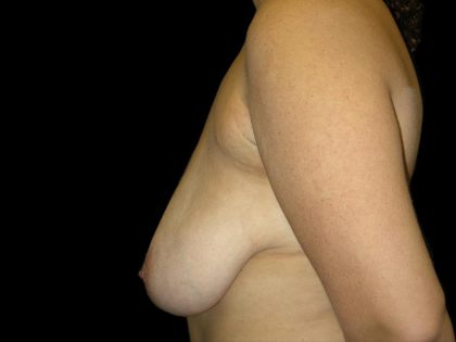 Breast Lift Before & After Patient #1205