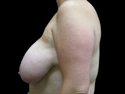 Breast Reduction Before & After Patient #1447