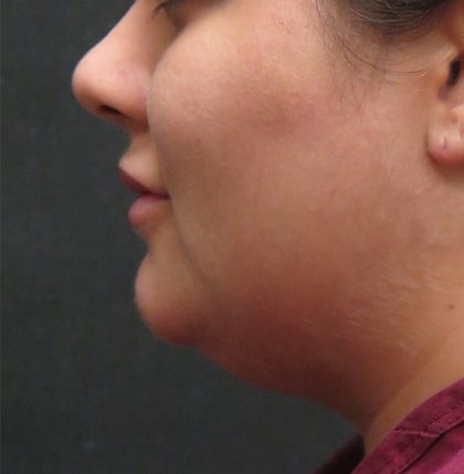 Scarless Facelift and Necklift Before & After Patient #3028