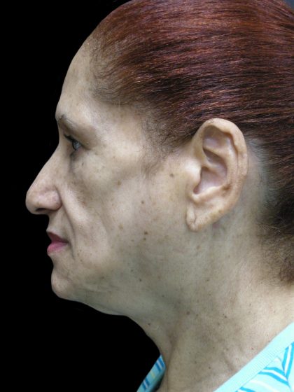 Fat Transfer Before & After Patient #1765