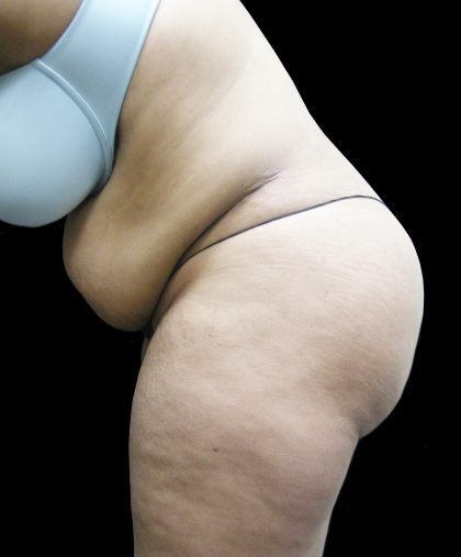 Tummy Tuck Before & After Patient #3166