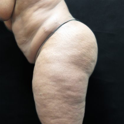 Tummy Tuck Before & After Patient #3267