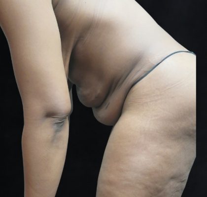 Tummy Tuck Before & After Patient #3387