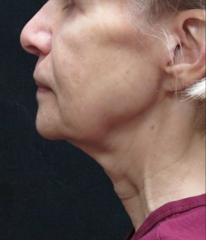 Levinelift Before & After Patient #2008
