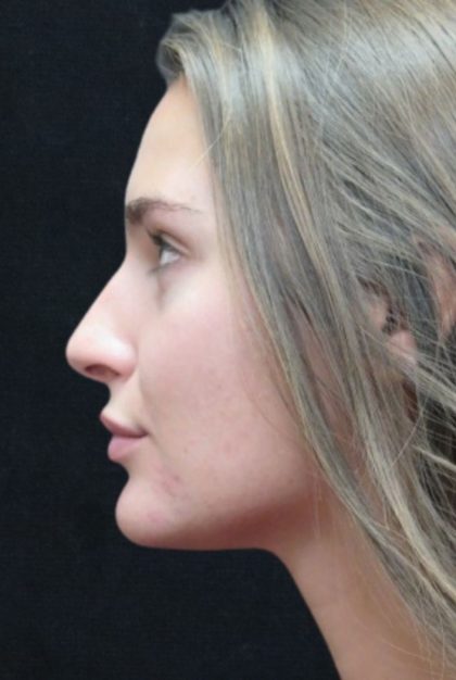 Rhinoplasty Before & After Patient #2926