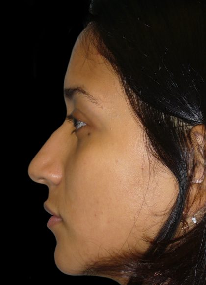 Rhinoplasty Before & After Patient #2905