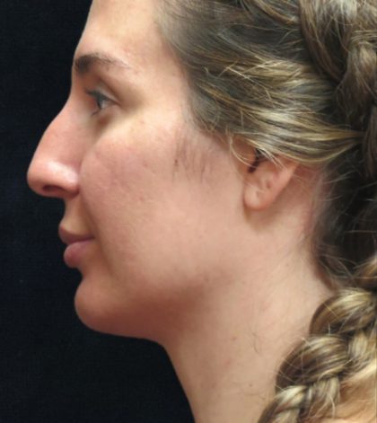 Rhinoplasty Before & After Patient #2851