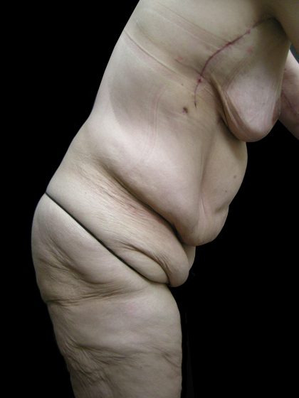Post Weight Loss Before & After Patient #2770