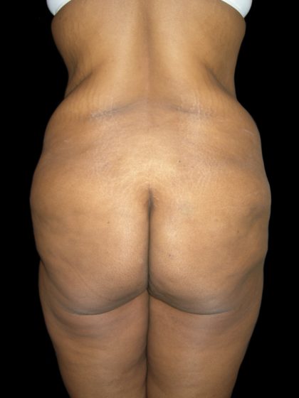 Lower Body Lift Before & After Patient #2327