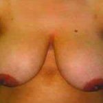 Breast Reduction Before & After Patient #1376