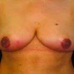 Breast Reduction Before & After Patient #1376