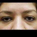 Eyelid Surgery Before & After Patient #1582