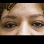 Eyelid Surgery Before & After Patient #1582