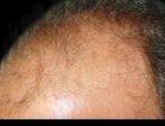 Hair Restoration Before & After Patient #1821