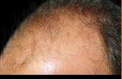 Hair Restoration Before & After Patient #1821