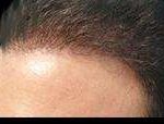 Hair Restoration Before & After Patient #1821