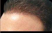 Hair Restoration Before & After Patient #1821