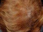 Hair Restoration Before & After Patient #1829