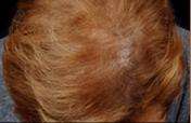Hair Restoration Before & After Patient #1829