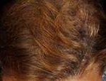 Hair Restoration Before & After Patient #1829