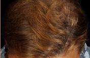 Hair Restoration Before & After Patient #1829