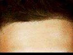 Hair Restoration Before & After Patient #1835