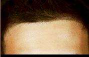 Hair Restoration Before & After Patient #1835