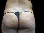 Liposuction Before & After Patient #2051