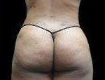 Liposuction Before & After Patient #2051