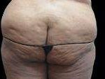 Liposuction Before & After Patient #2063