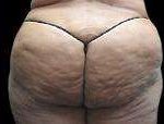 Liposuction Before & After Patient #2063