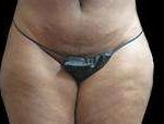 Liposuction Before & After Patient #2066