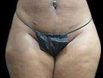 Liposuction Before & After Patient #2066