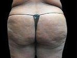 Liposuction Before & After Patient #2071