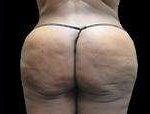 Liposuction Before & After Patient #2071