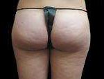 Liposuction Before & After Patient #2085